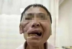 吃瓜下颚破皮视频,网友直呼太痛了