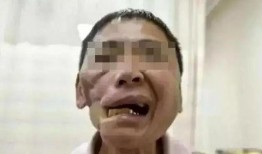 吃瓜下颚破皮视频,网友直呼太痛了